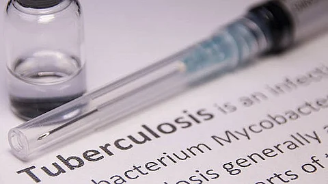 Deputy Chief Medical Officer (CMO) Dr. Yashveer Singh with the sputum of a critical tuberculosis (TB) patient. (Representational Image: Unsplash)