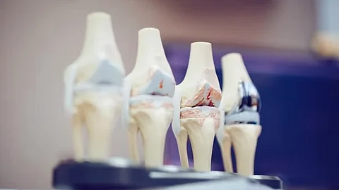 ARTHRITIS is the most commonly occurring joint disease worldwide. (Unsplash)