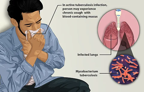 BPaL’s 6-month regimen for drug-resistant TB to be launched nationwide in January after training sessions conclude. (Wikimedia Commons)