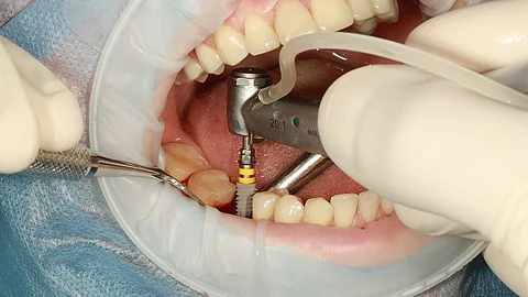 Patients are being recommended for full-mouth implants when less invasive options might have been available. (Representational Image: Wikimedia Commons)