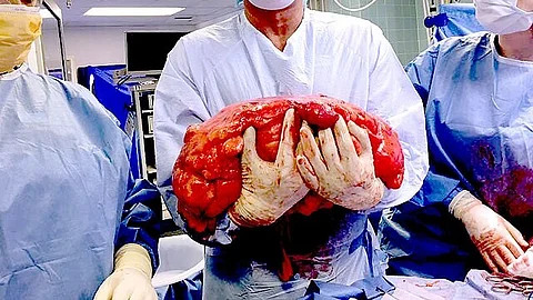 Giant Tumor No More: The Fortis Medical Team’s Life-Saving Surgery in Gurugram (Representational image: Wikimedia Commons)