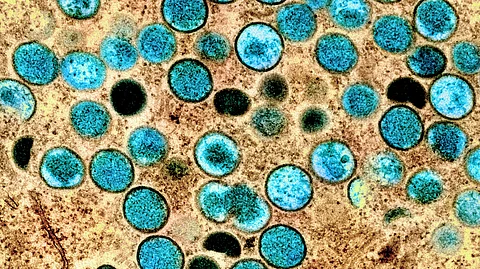 A virologist’s bold move: Beata Halassy used oncolytic virotherapy on herself, successfully shrinking her tumor using lab-grown viruses. (Representational Image-Wikimedia Commons)