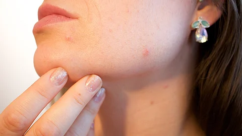 Acne is a common condition that happens when hair follicles under the skin become clogged. (Pixabay).