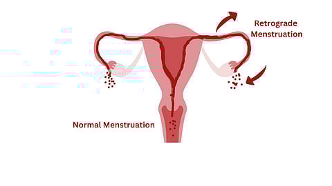 Around 90% of menstruating women experience some level of backward menstrual flow during normal periods. (Image: Edited by Josna Lewis on canva)