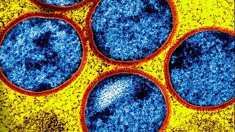 California reports first U.S. case of Clade I Mpox variant. (Image: Wikimedia Commons)