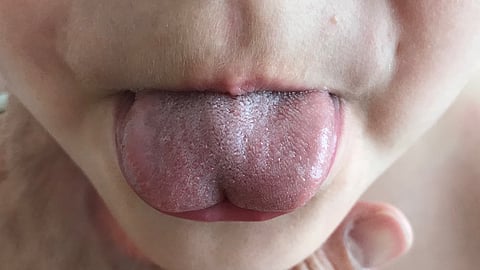 A new light on pediatric dentistry: Treating halitosis with blue LED and natural annatto colorant. (Representational Image-Wikimedia Commons)