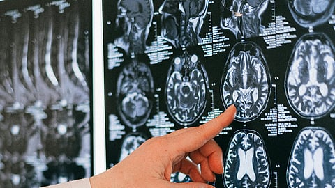 FDA-approved drugs may be repurposed to target disease-associated microglia in Alzheimer’s disease without affecting the healthy type. (Image: Pexels)