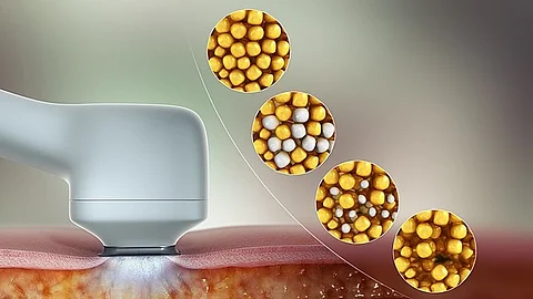 A fat-freezing treatment designed to reduce stubborn fat in targeted areas such as the stomach, arms, thighs, and chin. (Image: Wikimedia Commons)