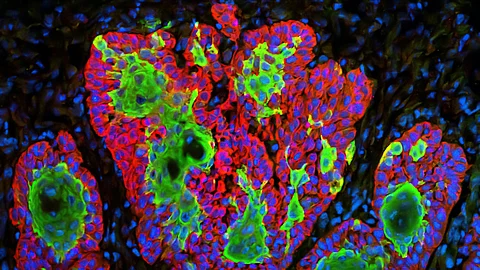 Transforming Skin Cancer Identification. (Representational image: UNSPLASH)
