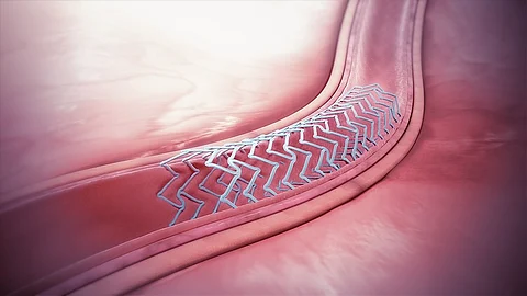 Laser patterning technology applied to stent surfaces, creating nano and micro-scale wrinkle patterns to promote endothelial cell growth and prevent restenosis.