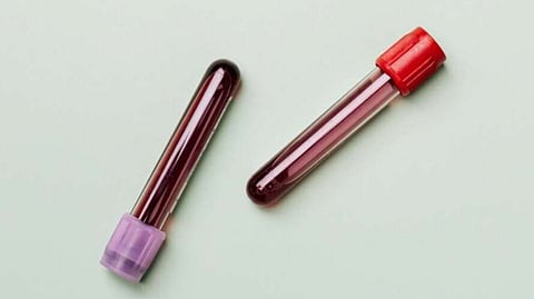 Rutgers Health scientists identified a blood test that can diagnose asthma and assess its severity, potentially transforming asthma diagnosis, monitoring, and treatment