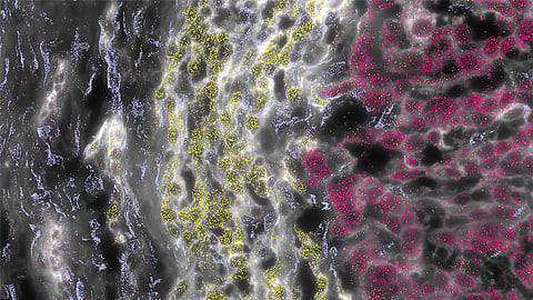 Histological section of an FLC tumor, showing the stromal (left), normal (center), and tumor (right) cells. The colors correspond to gene markers identified for different cell types.