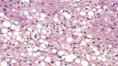Fatty liver is the accumulation of fat in liver cells. Also known as Hepatic stenosis.