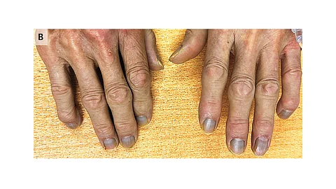 Silver ions tend to accumulate in various tissues, including the skin, heart, liver, lungs, and even the brain. (Image Credits: The New England Journal of Medicine)