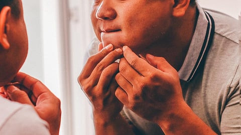 Popping a pimple might seem like a quick fix, but it comes with risks that far outweigh the temporary relief.