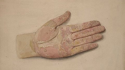 40-year-old man noticed thick, yellowish substance leaking from his hands after following the carnivore diet. (Representational image: Wikimedia Commons)