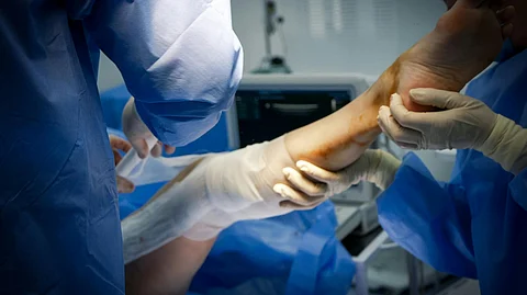 South Asia leads with 2.68 million traumatic amputation cases, while East Asia reports the lowest rates at 101.01 cases per 100,000 population