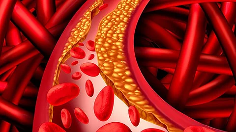 Study Reveals Shocking Results: "Good Cholesterol" Linked to Development of Glaucoma. (Representational image: Wikimedia Commons)