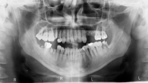 Wisdom tooth and what problems does it cause when not erupted properly.