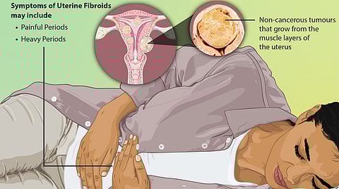 Uterine Fibroids: Understanding Their Impact on Women's Health.