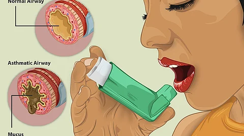 Illustration depicting the use of an inhaler for asthma management, highlighting the difference between normal and asthmatic airways.