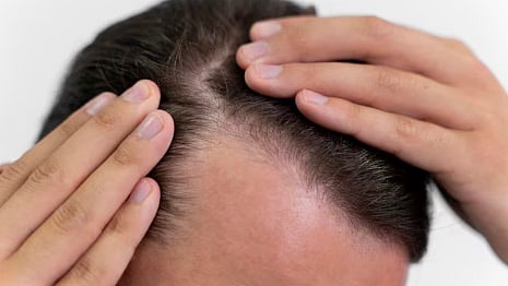 Over 300 Villagers in Maharashtra Lose Hair Due to Contaminated Wheat