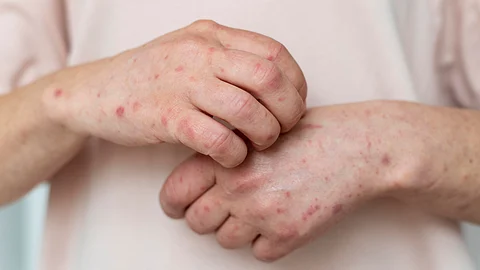 Measles is a respiratory virus that can survive in the air for up to two hours.