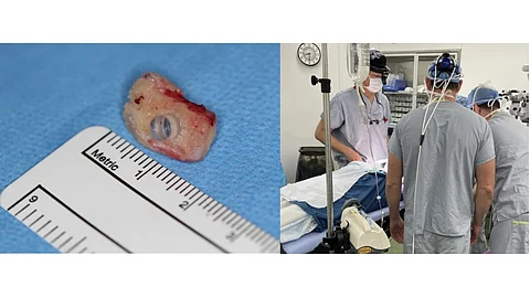 The surgery involves implanting a specially modified tooth into the eye to serve as a foundation for a new cornea.