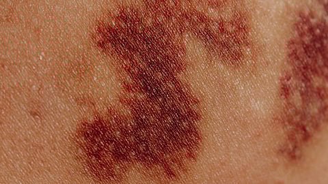 Close-up of Bruises on Body