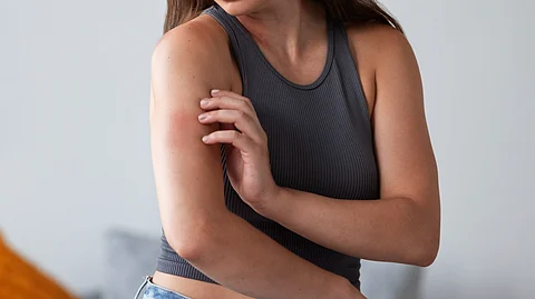 Women suffering from rash