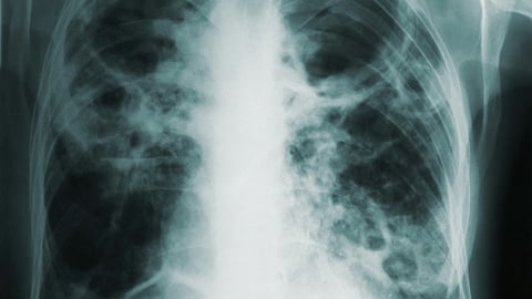 Close-up of chest X-ray showing white patches and dark areas indicating infiltrates and cavities in lung.