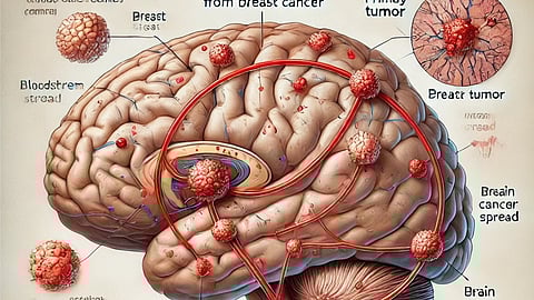 Illustrative image showing brain tumor spread via blood from breast.