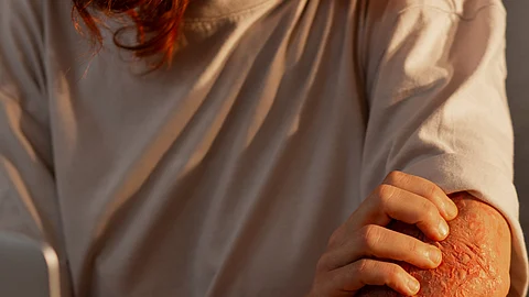 A woman suffering from a rash