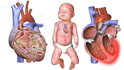 Medical illustration of Kawasaki disease showing its impact on an infant's heart.