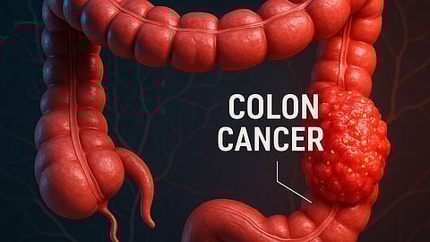 Illustrative image of colon showing an enlargement on an area indicating tumor.