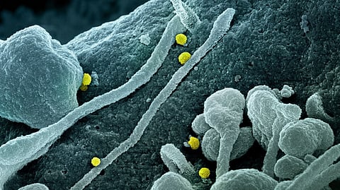 Colorized Scanning Electron Microscope image of CCHFV particles (yellow) emerging from patient cells.