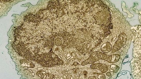 Cellular structure image showing multiple myeloma cells studied for lenalidomide resistance.