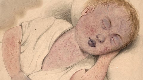 Watercolour drawing of a child with measles.