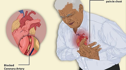 A human heart showing blockage of the artery, also a man who is having arrhythmia, clutching his chest in pain