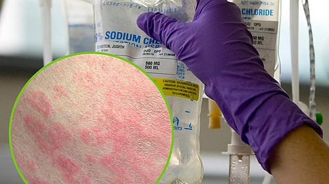 A person wearing purple gloves is hanging an IV infusion bag labeled 'Sodium Chloride'.