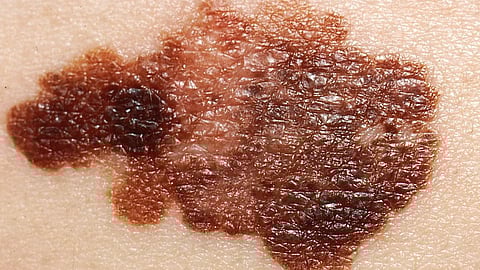 A close-up image of brown patch on a patient's skin indicating melanoma.