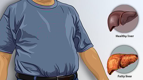 A man suffering from fatty liver. A liver with fat deposits has been shown, & for comparison, a healthy liver as well.