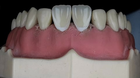 A model of tooth with gums on it