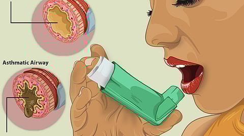 Illustration depicting the use of an inhaler for asthma management.