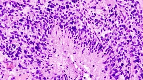 Histopathological image of cerebral glioblastoma in Hematoxylin & eosin stain.