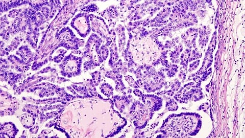Histopathological image of serous adenocarcinoma arising in bilateral ovaries. Hematoxylin & eosin stain.