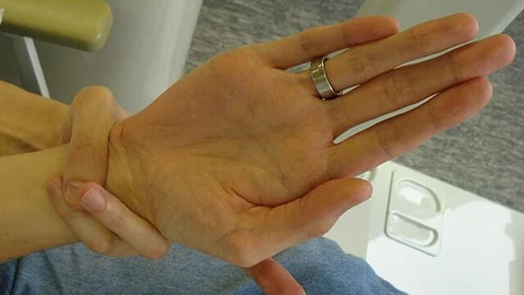 A positive wrist sign the thumb and little finger overlap, when grasping the wrist of the opposite hand.
