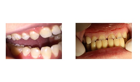 tooth attrition and tooth abrasion