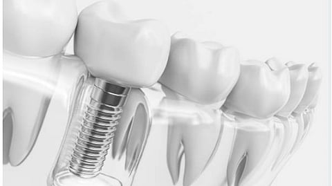 A close-up image of a transparent model of dental implant showing the metallic screw going into jawbone.
