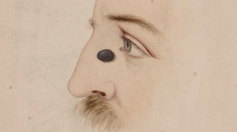 Man with a melanotic wart on the side of his nose